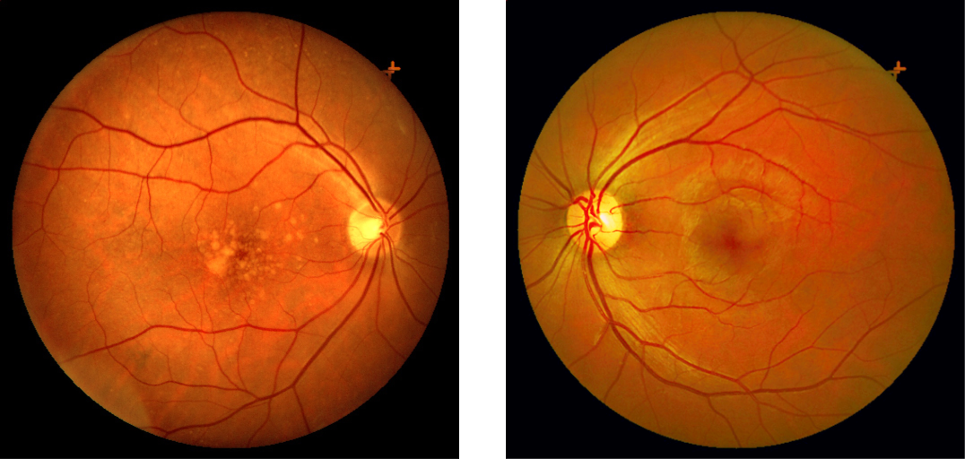 Macular Degeneration